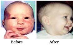 Birth Mark Removal Clinic India, Laser Skin Treatment Clinic India, Cosmetic Issue